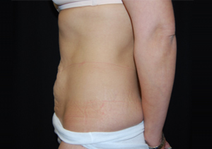 Tummy Tuck Before & After Patient #24347