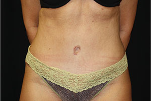 Tummy Tuck Before & After Patient #24352