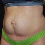 Tummy Tuck Before & After Patient #24352