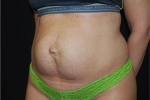 Tummy Tuck Before & After Patient #24352