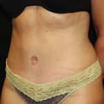 Tummy Tuck Before & After Patient #24352