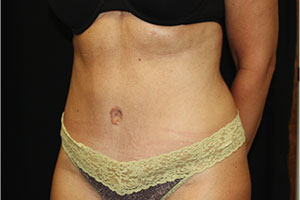 Tummy Tuck Before & After Patient #24352