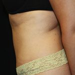 Tummy Tuck Before & After Patient #24352