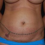 Tummy Tuck Before & After Patient #24365