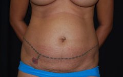 Tummy Tuck Before & After Patient #24365