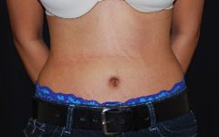 Tummy Tuck Before & After Patient #24365