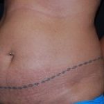 Tummy Tuck Before & After Patient #24365