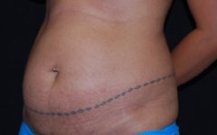Tummy Tuck Before & After Patient #24365