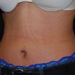 Tummy Tuck Before & After Patient #24365