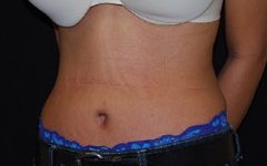 Tummy Tuck Before & After Patient #24365