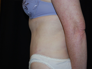Tummy Tuck Before & After Patient #24366