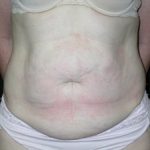 Tummy Tuck Before & After Patient #24366