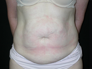 Tummy Tuck Before & After Patient #24366