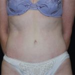 Tummy Tuck Before & After Patient #24366