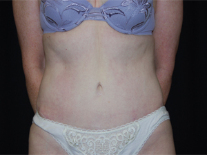 Tummy Tuck Before & After Patient #24366