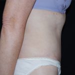 Tummy Tuck Before & After Patient #24366