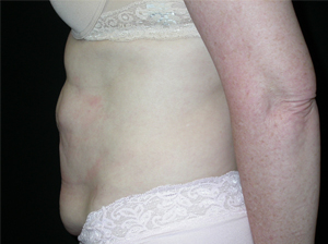 Tummy Tuck Before & After Patient #24366
