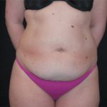 Tummy Tuck Before & After Patient #24383