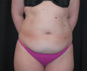 Tummy Tuck Before & After Patient #24383