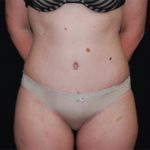 Tummy Tuck Before & After Patient #24383