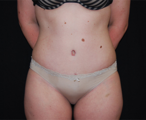 Tummy Tuck Before & After Patient #24383