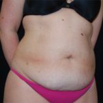 Tummy Tuck Before & After Patient #24383