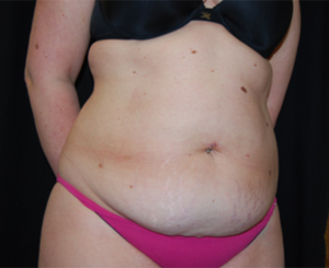 Tummy Tuck Before & After Patient #24383