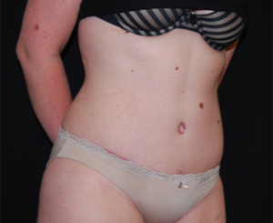 Tummy Tuck Before & After Patient #24383