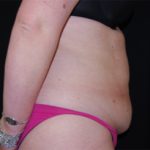 Tummy Tuck Before & After Patient #24383