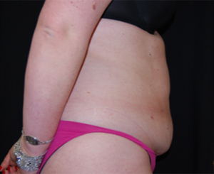 Tummy Tuck Before & After Patient #24383