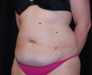 Tummy Tuck Before & After Patient #24383