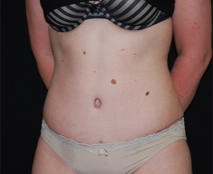 Tummy Tuck Before & After Patient #24383