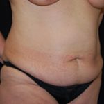 Tummy Tuck Before & After Patient #24384