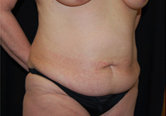 Tummy Tuck Before & After Patient #24384