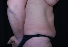 Tummy Tuck Before & After Patient #24384