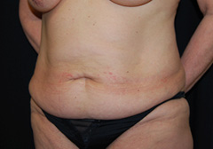 Tummy Tuck Before & After Patient #24384