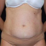 Tummy Tuck Before & After Patient #24403