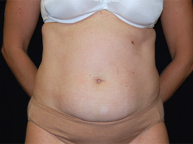 Tummy Tuck Before & After Patient #24403