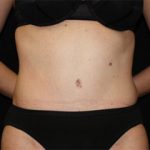 Tummy Tuck Before & After Patient #24403