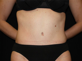 Tummy Tuck Before & After Patient #24403