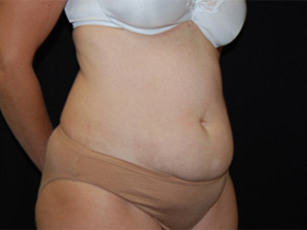 Tummy Tuck Before & After Patient #24403