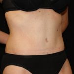 Tummy Tuck Before & After Patient #24403