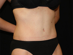 Tummy Tuck Before & After Patient #24403