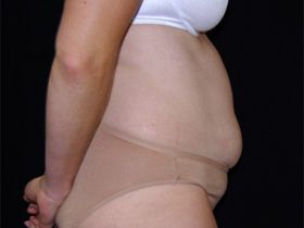 Tummy Tuck Before & After Patient #24403