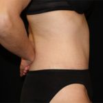 Tummy Tuck Before & After Patient #24403