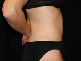 Tummy Tuck Before & After Patient #24403