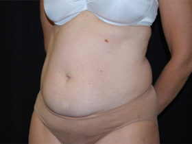 Tummy Tuck Before & After Patient #24403