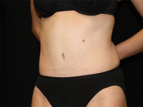 Tummy Tuck Before & After Patient #24403