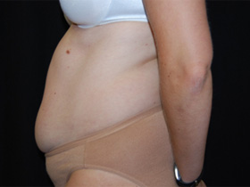 Tummy Tuck Before & After Patient #24403