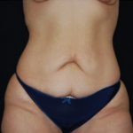 Tummy Tuck Before & After Patient #19985